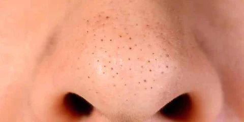 erros comuns ao tentar remover cravos pretos