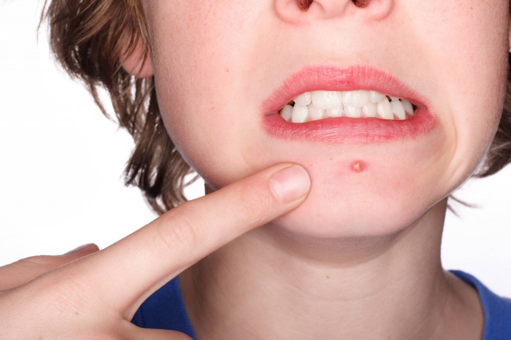 Os Melhores Ativos para Combater a Acne: Guia Completo