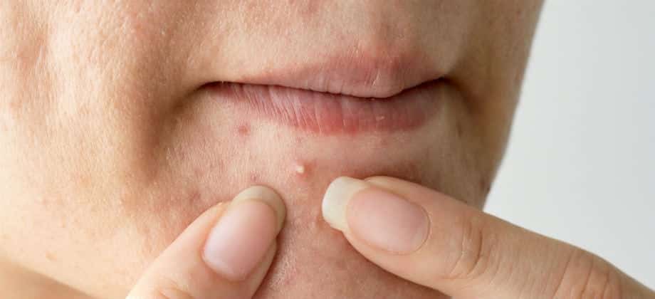 Rotina de Skincare Essencial para Peles Oleosas e Acneicas