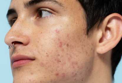 Como Evitar Manchas e Cicatrizes de Espinhas: Dicas de Dermatologistas