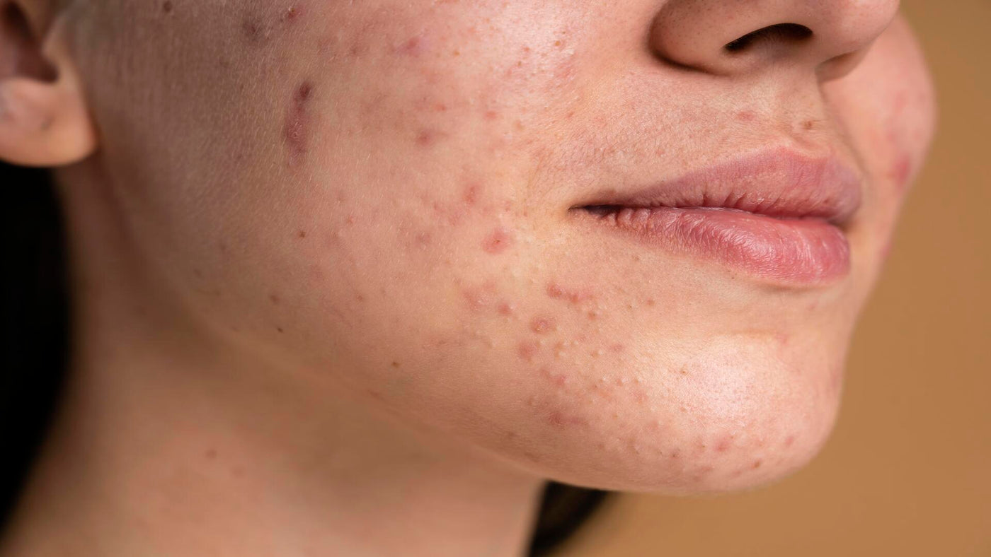 Os Melhores Ativos para Combater a Acne: Guia Completo