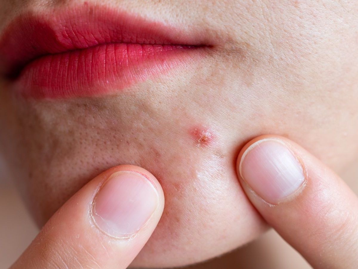 Isotretinoína (Roacutan): O Que Você Precisa Saber Antes de Usar